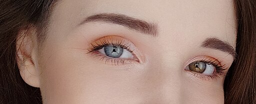 Heterochromia_iridis